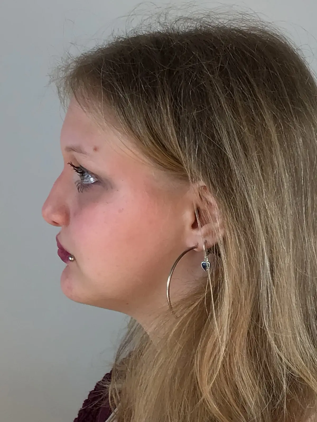 Case--1262 | Before Rhinoplasty
