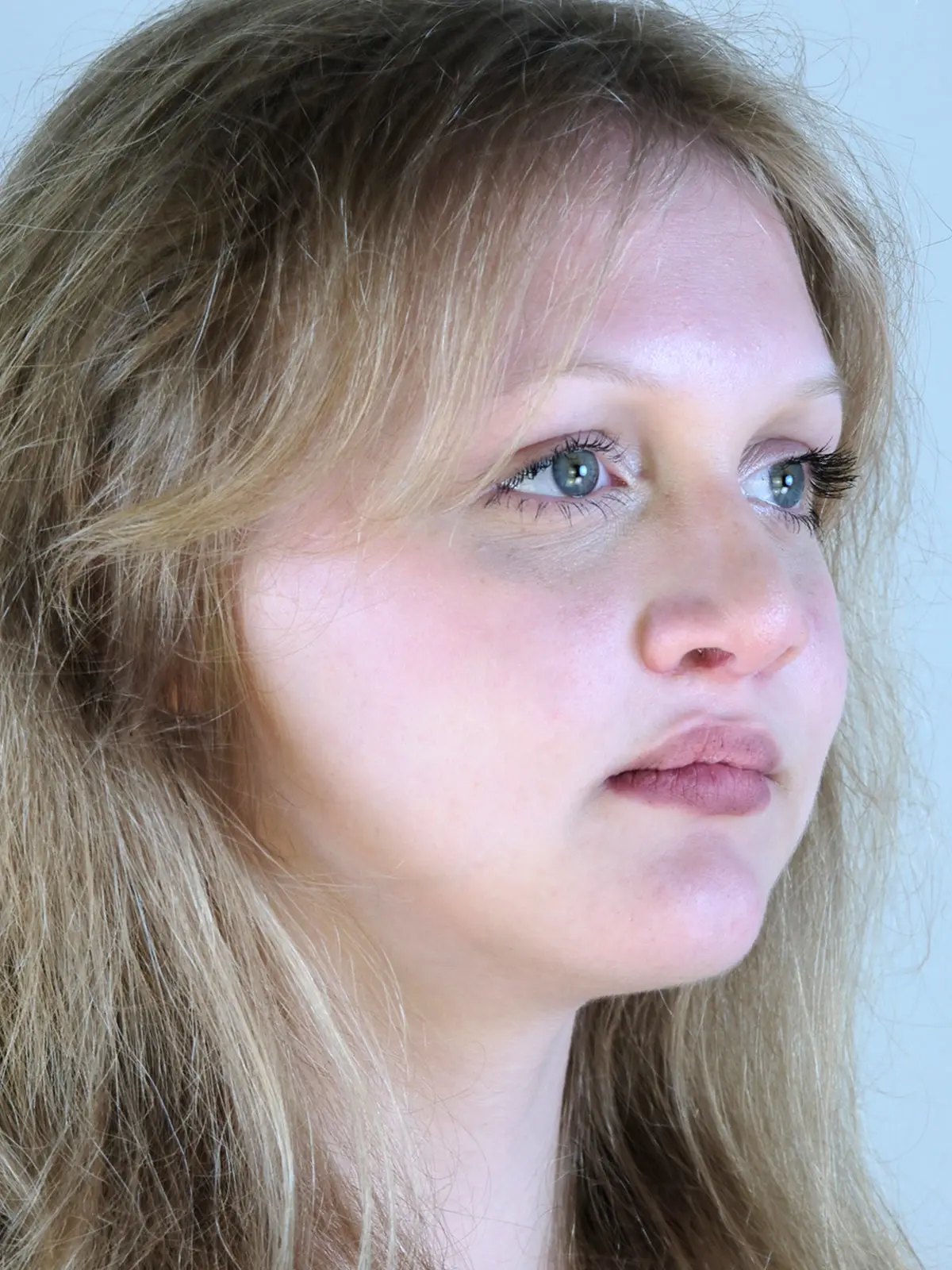 Case--1262 | After Rhinoplasty 2